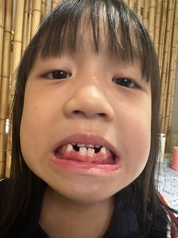 掉了两颗牙